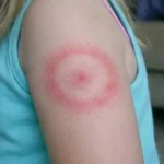 How to identify and cure skin fungus or ringworm.