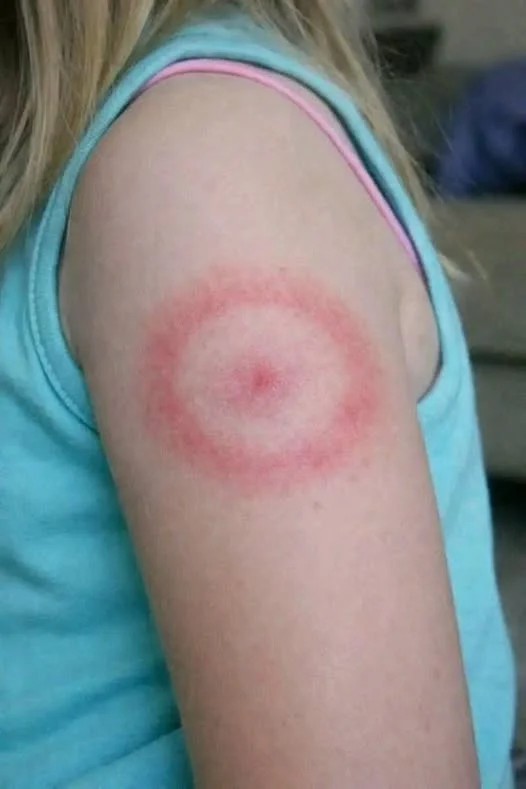 How to identify and cure skin fungus or ringworm.